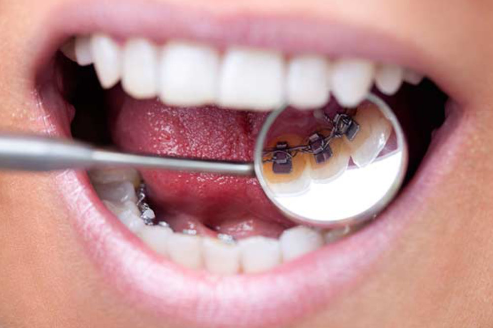 Lingual Braces at Jensen Orthodontic Arts